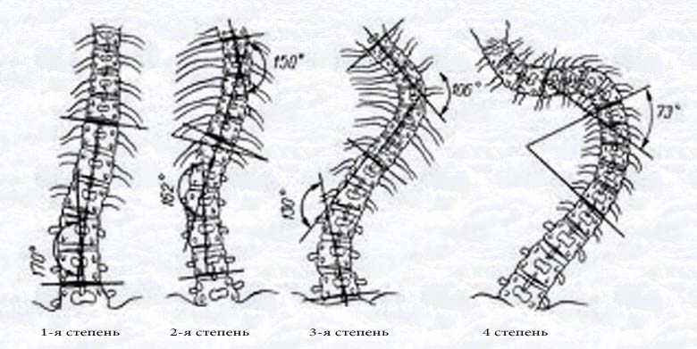 Степени сколиоза